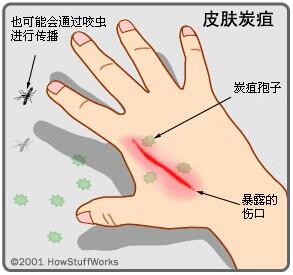 炭疽杆菌能治好吗？皮肤炭疽病的症状图片 炭疽病图片人图片