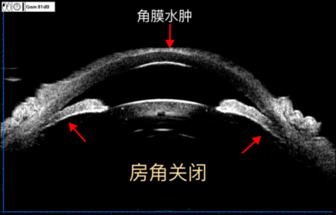 新冠病毒很可能存在眼部趋向性,究竟是怎么一回事?