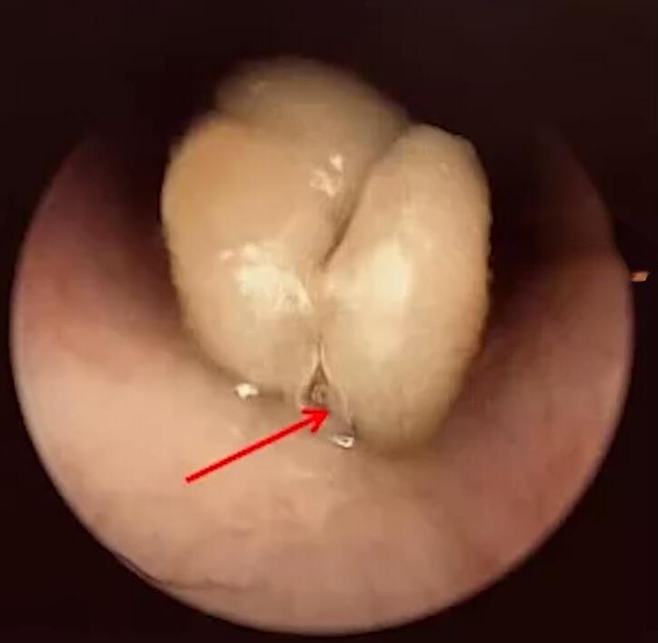 2岁宝宝果核卡气管10天后竟发芽是怎么回事?