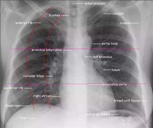 秒懂教学！这下终于会看胸片了 如何看胸片