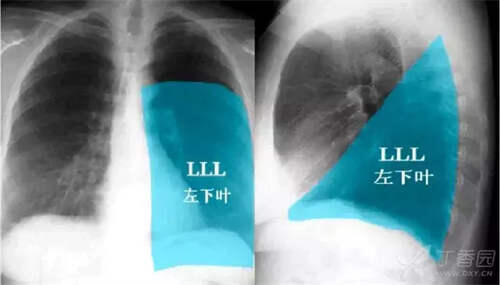 秒懂教学！这下终于会看胸片了 如何看胸片