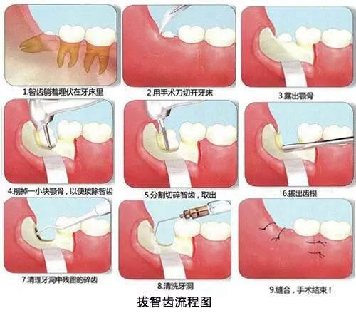 拔智齿后遗症太多了